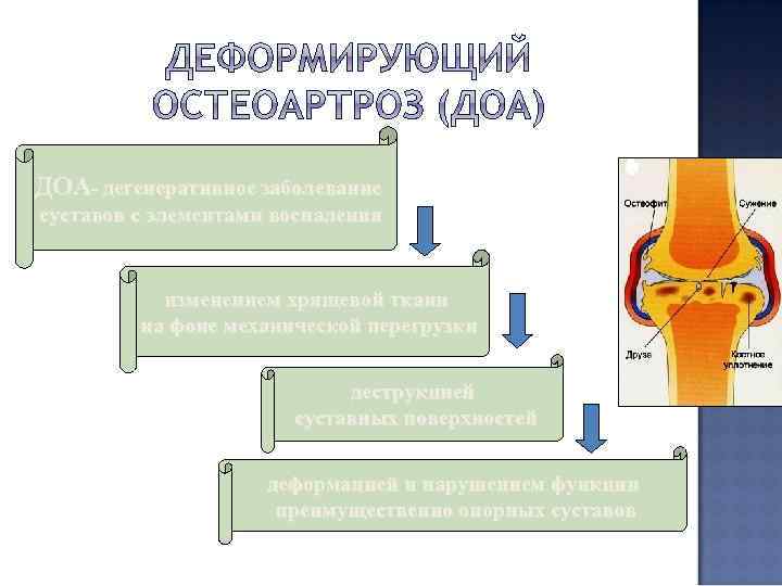 ДОА- дегенеративное заболевание суставов с элементами воспаления изменением хрящевой ткани на фоне механической перегрузки