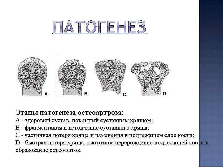Этапы патогенеза остеоартроза: A - здоровый сустав, покрытый суставным хрящом; B - фрагментация и