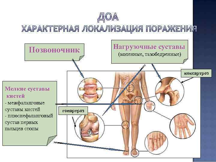 Позвоночник Нагрузочные суставы (коленные, тазобедренные) коксартроз Мелкие суставы кистей - межфаланговые суставы кистей -