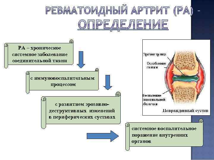РА – хроническое системное заболевание соединительной ткани с иммуновоспалительным процессом с развитием эрозивнодеструктивных изменений