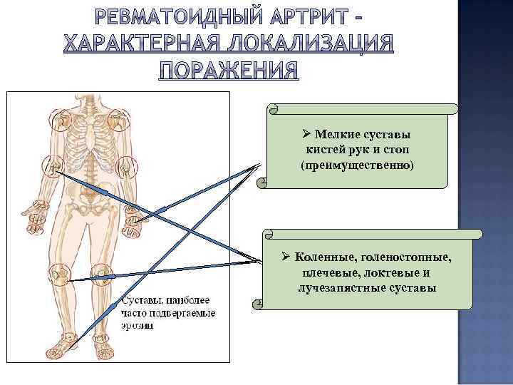 Ø Мелкие суставы кистей рук и стоп (преимущественно) Ø Коленные, голеностопные, плечевые, локтевые и