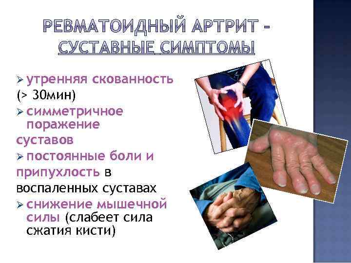 Ø утренняя скованность (> 30 мин) Ø симметричное поражение суставов Ø постоянные боли и