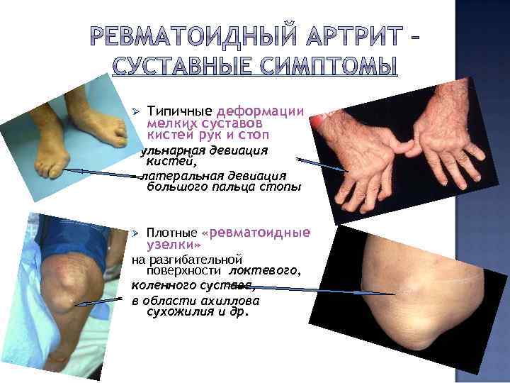 Ø Типичные деформации мелких суставов кистей рук и стоп - ульнарная девиация кистей, -