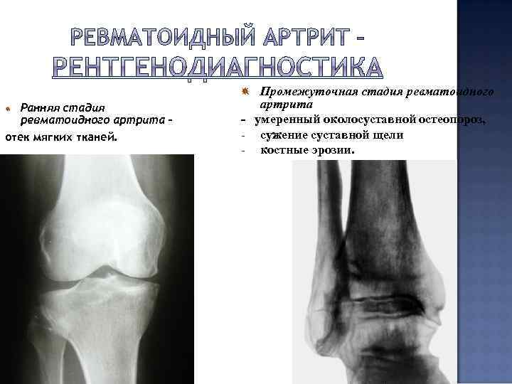 Ранняя стадия ревматоидного артрита – отек мягких тканей. Промежуточная стадия ревматоидного артрита - умеренный