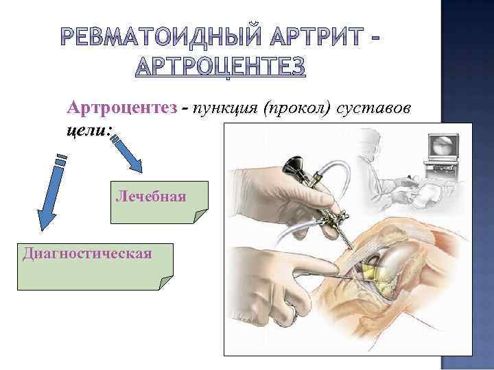 Артроцентез - пункция (прокол) суставов цели: Лечебная Диагностическая 