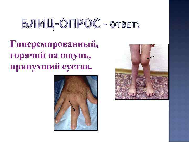 Гиперемированный, горячий на ощупь, припухший сустав. 