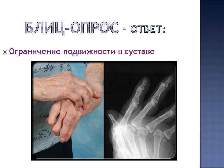  Ограничение подвижности в суставе 