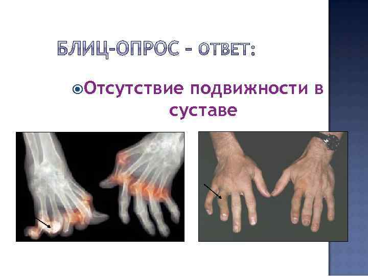  Отсутствие подвижности в суставе 