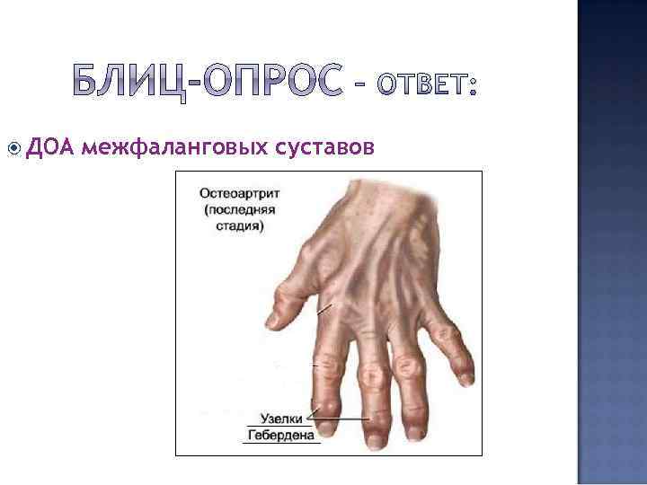  ДОА межфаланговых суставов 