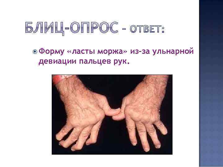  Форму «ласты моржа» из-за ульнарной девиации пальцев рук. 
