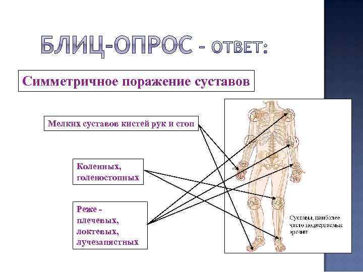 Симметричное поражение суставов Мелких суставов кистей рук и стоп Коленных, голеностопных Реже плечевых, локтевых,