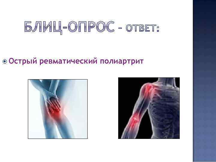  Острый ревматический полиартрит 