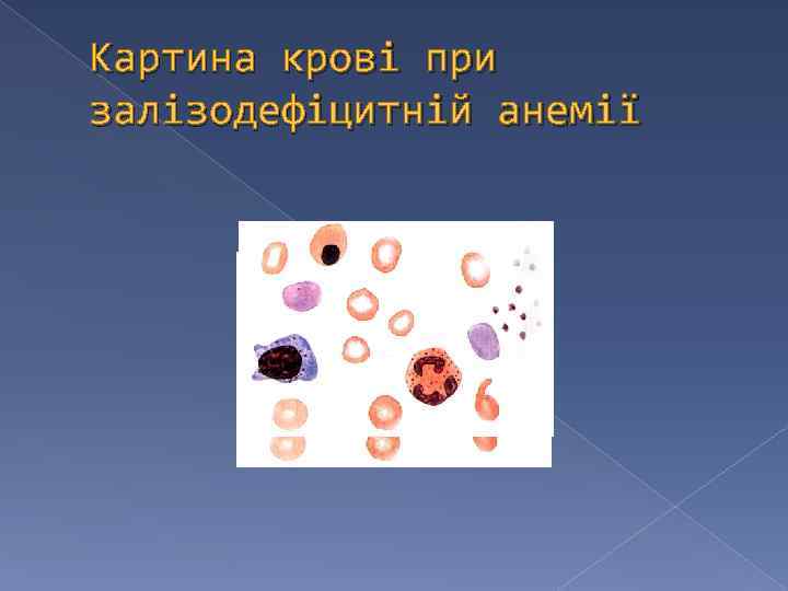 Картина крові при залізодефіцитній анемії 