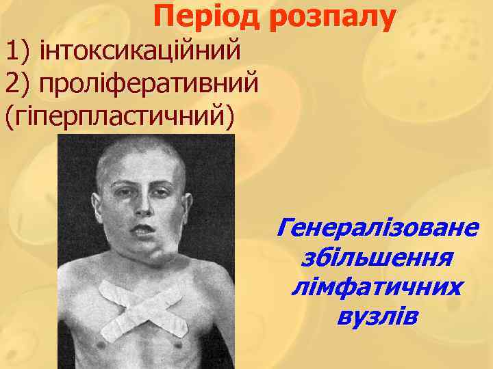 Період розпалу 1) інтоксикаційний 2) проліферативний (гіперпластичний) Генералізоване збільшення лімфатичних вузлів 