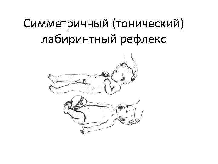Симметричный (тонический) лабиринтный рефлекс 