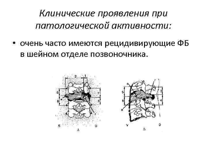 Клинические проявления при патологической активности: • очень часто имеются рецидивирующие ФБ в шейном отделе