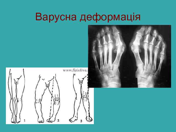 Варусна деформація 