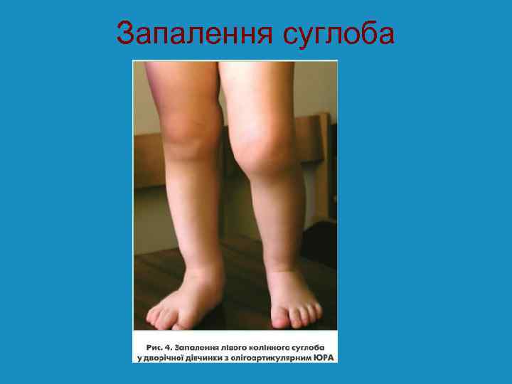 Запалення суглоба 