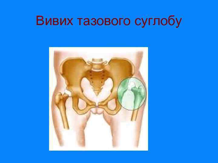 Вивих тазового суглобу 