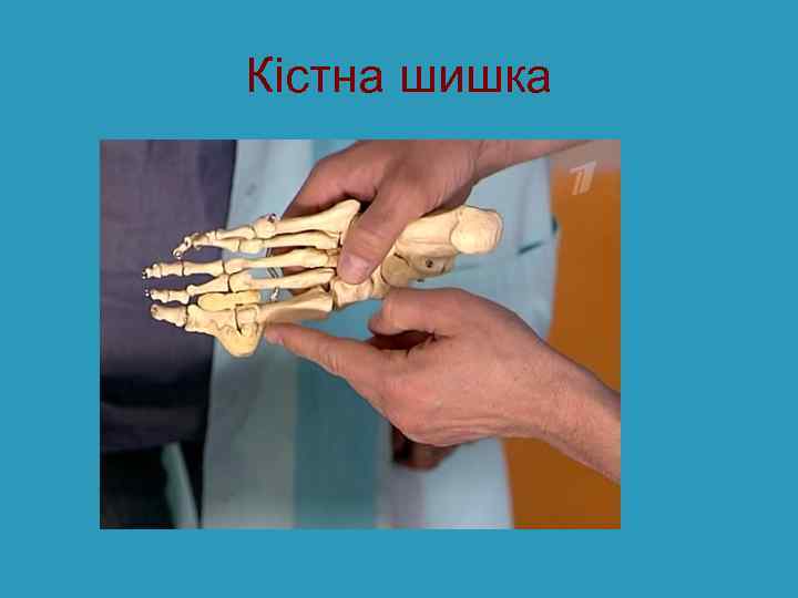 Кістна шишка 