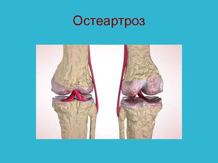 Остеартроз 