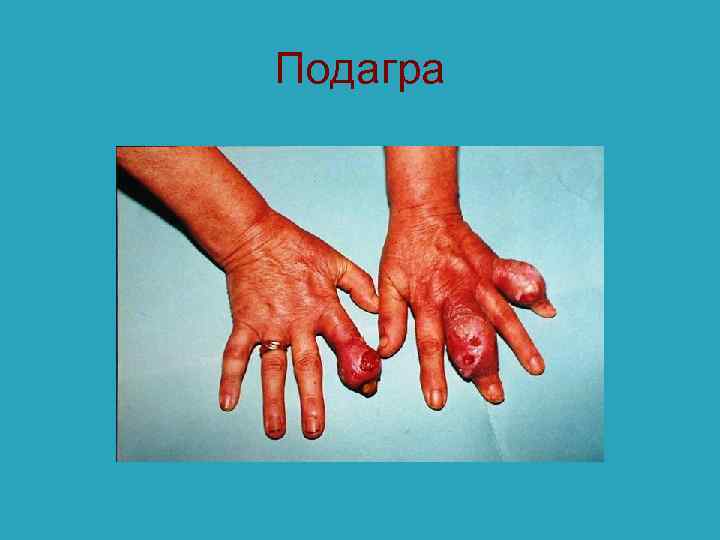 Подагра 