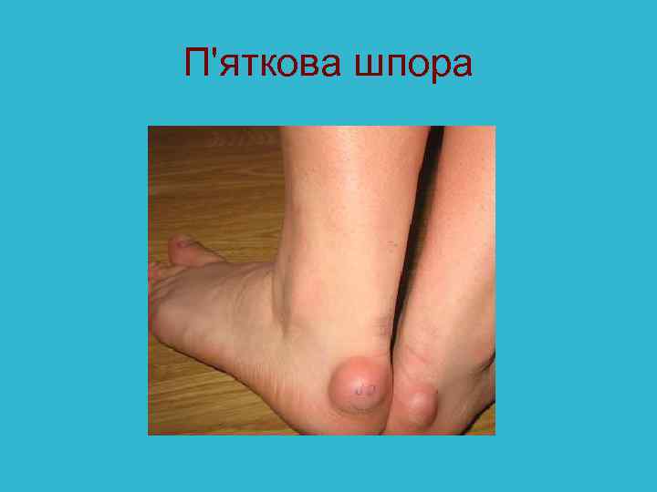 П'яткова шпора 