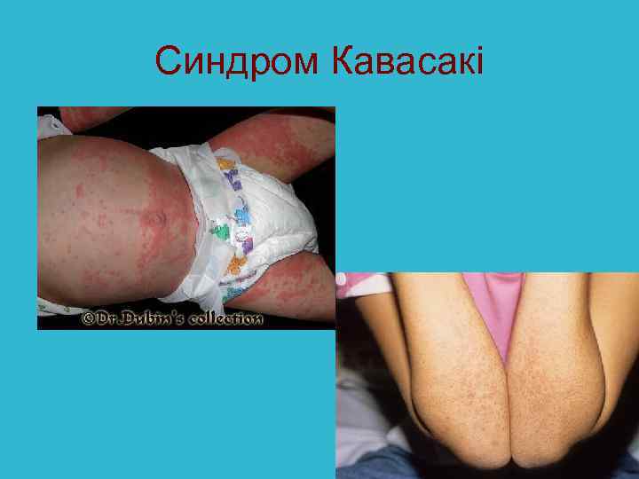 Синдром Кавасакі 