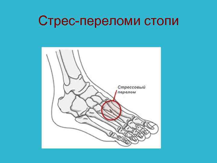 Стрес-переломи стопи 