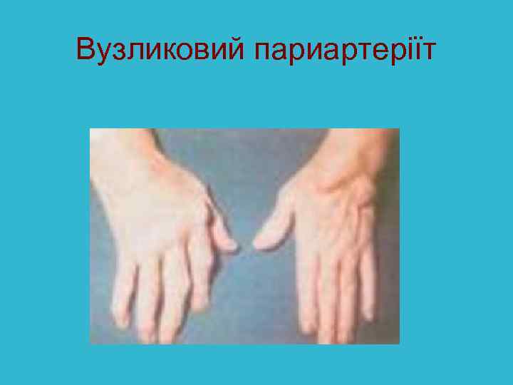 Вузликовий париартеріїт 