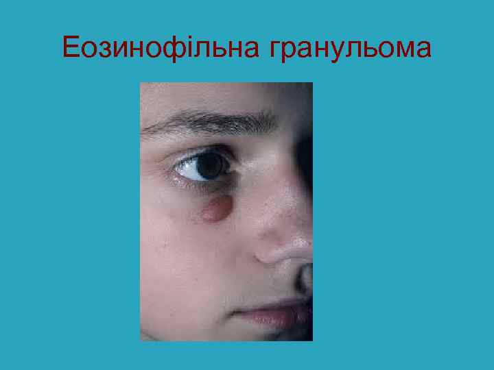 Еозинофільна гранульома 