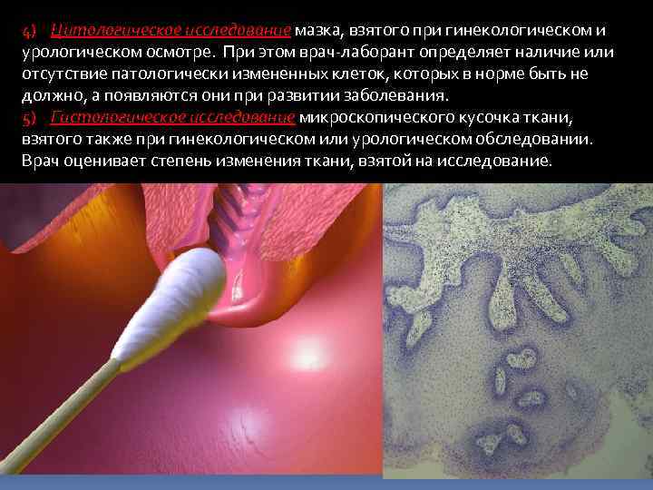 4) Цитологическое исследование мазка, взятого при гинекологическом и урологическом осмотре. При этом врач-лаборант определяет