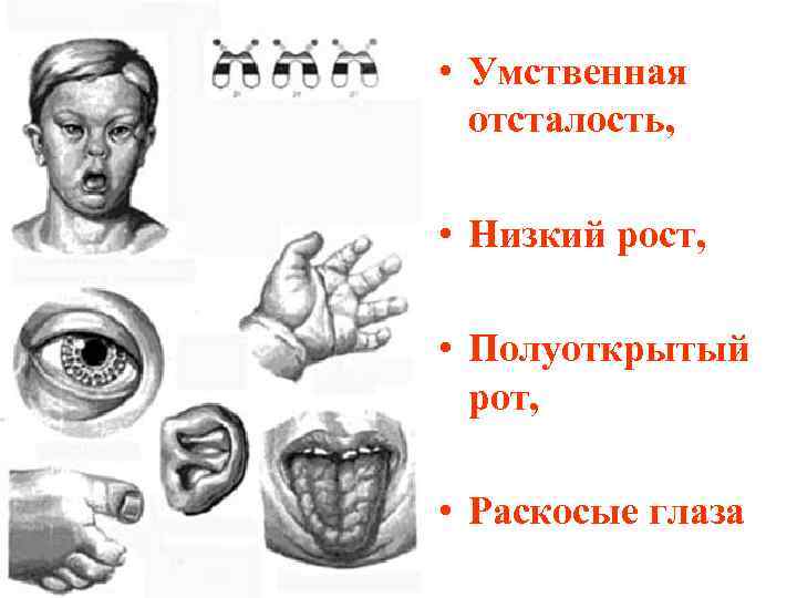  • Умственная отсталость, • Низкий рост, • Полуоткрытый рот, • Раскосые глаза 