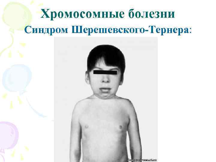 Хромосомные болезни Синдром Шерешевского-Тернера: 