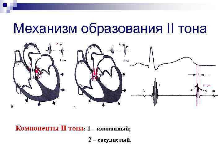 Механизм образования II тона Компоненты II тона: 1 – клапанный; 2 – сосудистый. 