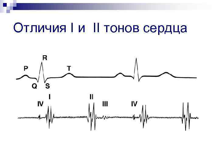 Отличия I и II тонов сердца 