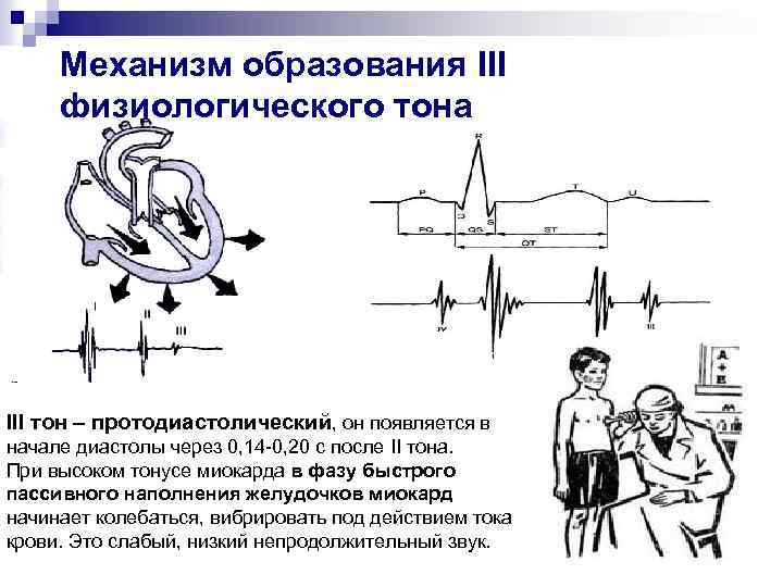 Механизм образования III физиологического тона III тон – протодиастолический, он появляется в начале диастолы