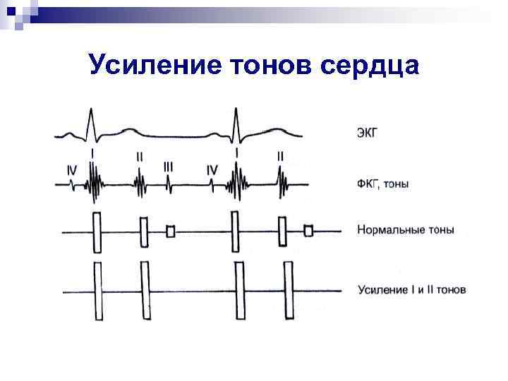 Усиление тонов сердца 