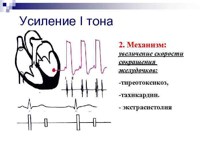 Усиление I тона 2. Механизм: увеличение скорости сокращения желудочков: -тиреотоксикоз, -тахикардии. - экстрасистолия 