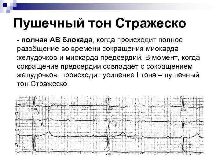 Пушечный тон Стражеско - полная АВ блокада, когда происходит полное разобщение во времени сокращения