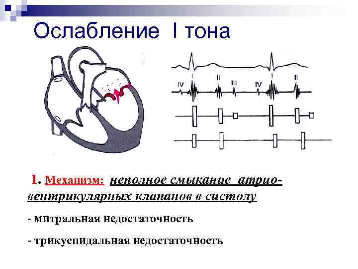 Ослабление I тона 1. Механизм: неполное смыкание атриовентрикулярных клапанов в систолу - митральная недостаточность