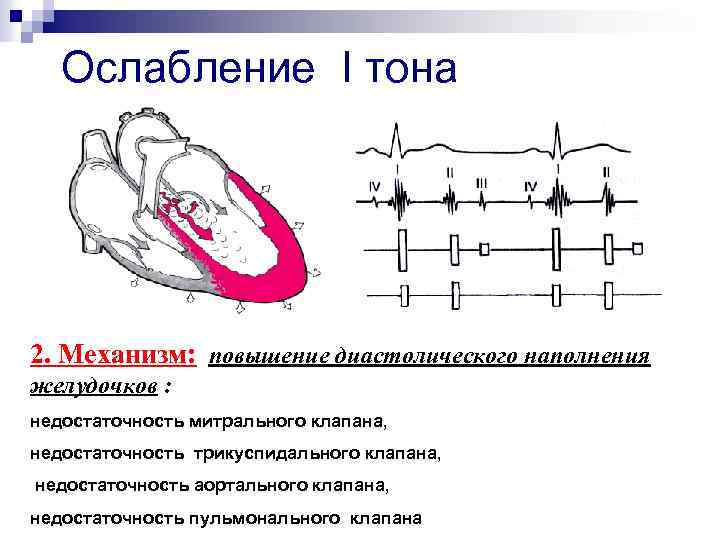 Ослабление I тона 2. Механизм: повышение диастолического наполнения желудочков : недостаточность митрального клапана, недостаточность