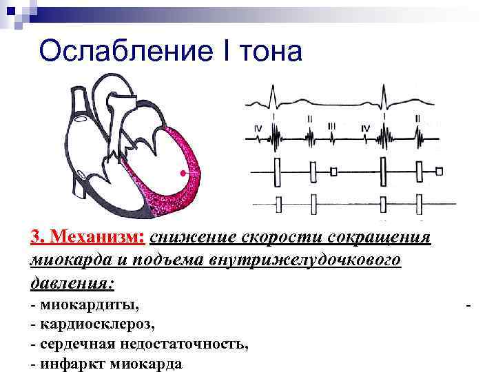 Ослабление I тона 3. Механизм: снижение скорости сокращения миокарда и подъема внутрижелудочкового давления: -