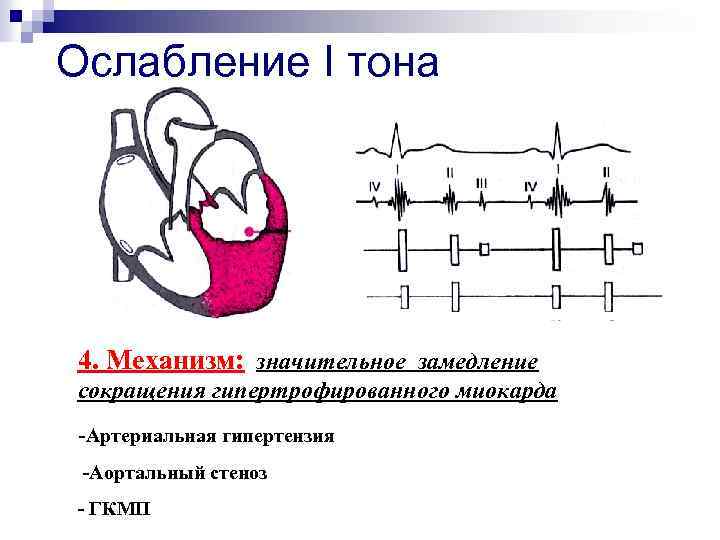 Ослабление I тона 4. Механизм: значительное замедление сокращения гипертрофированного миокарда -Артериальная гипертензия -Аортальный стеноз