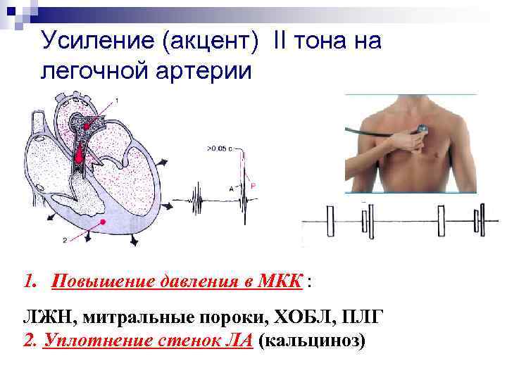 Усиление (акцент) II тона на легочной артерии 1. Повышение давления в МКК : ЛЖН,