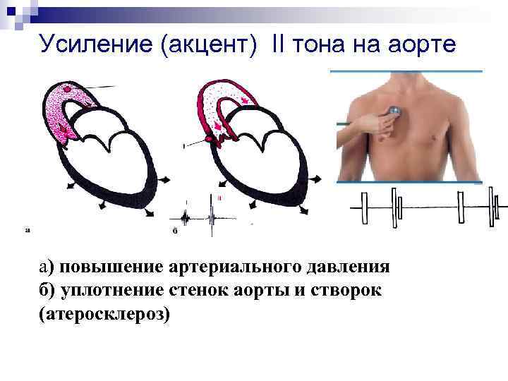 Усиление (акцент) II тона на аорте а) повышение артериального давления б) уплотнение стенок аорты