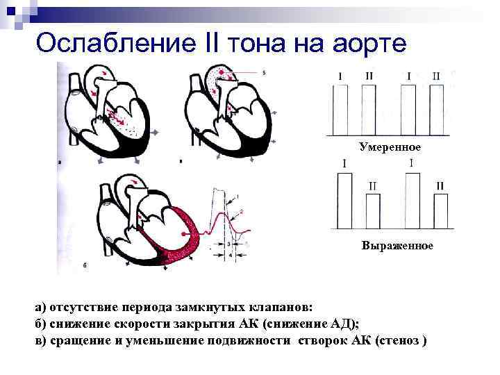 Ослабление II тона на аорте Умеренное Выраженное а) отсутствие периода замкнутых клапанов: б) снижение