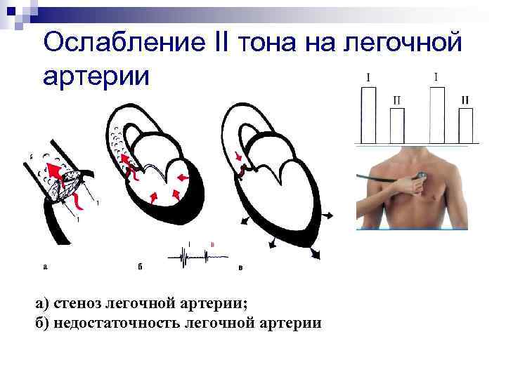 Ослабление II тона на легочной артерии а) стеноз легочной артерии; б) недостаточность легочной артерии