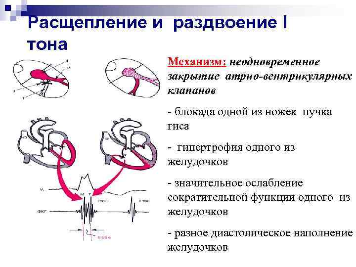 Расщепление и раздвоение I тона Механизм: неодновременное закрытие атрио-вентрикулярных клапанов - блокада одной из