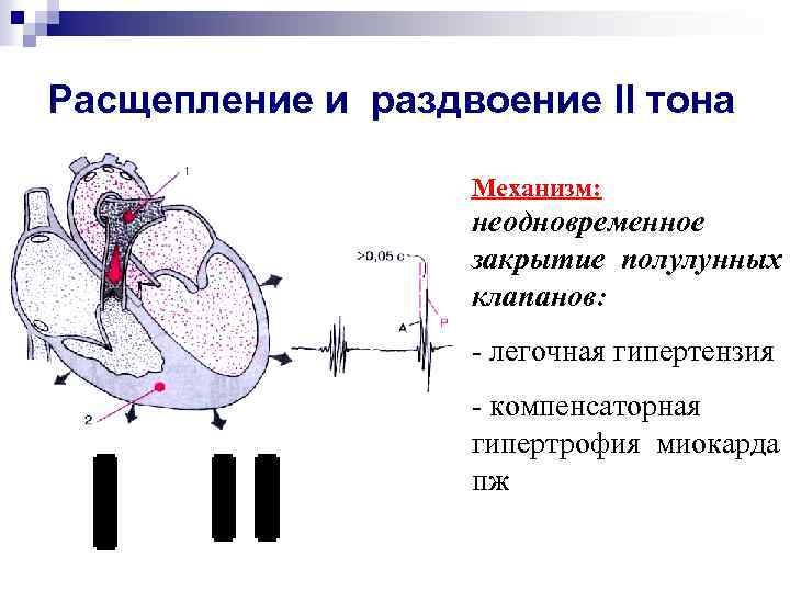 Расщепление и раздвоение II тона Механизм: неодновременное закрытие полулунных клапанов: - легочная гипертензия -